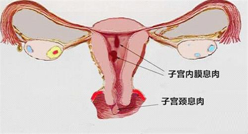 子宫内膜息肉2cm算大吗